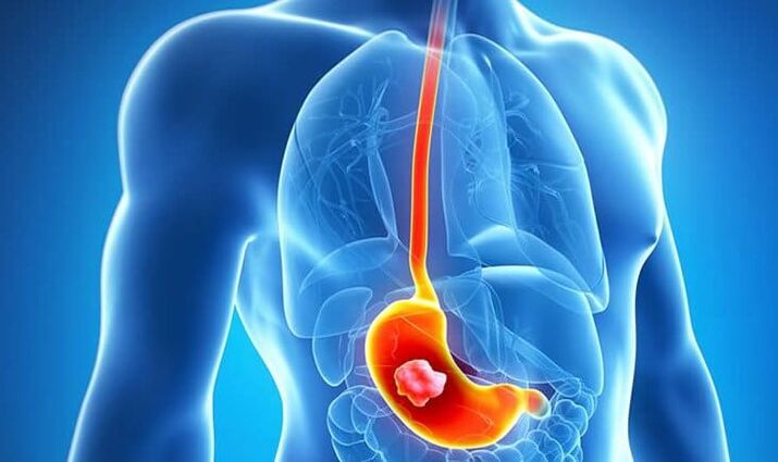It is contraindicated to follow the Dukan diet if you have a stomach ulcer.